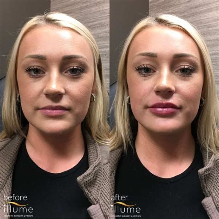 Alabama Barker Lip Fillers: Before And After Photos