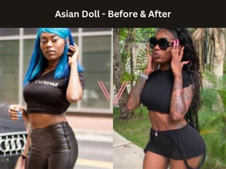 Asian Doll BBL Surgery: Before And After Photos