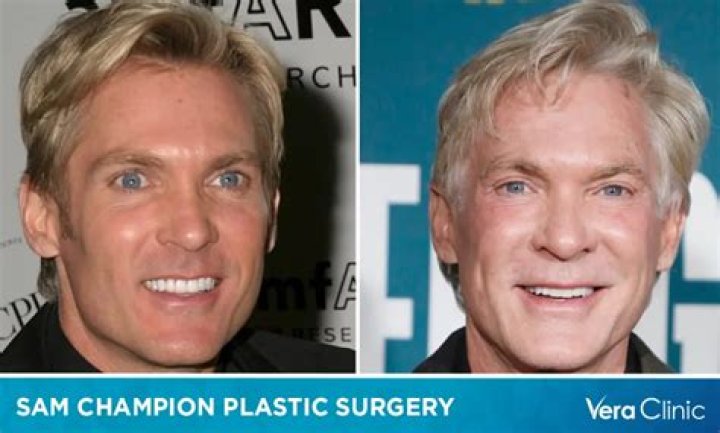 Here's Why Anchor Sam Champion Had A Surgery Back In 2010