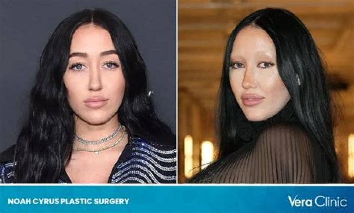 Noah Cyrus's Plastic Surgery Speculations and Experts' Take On Her Looks