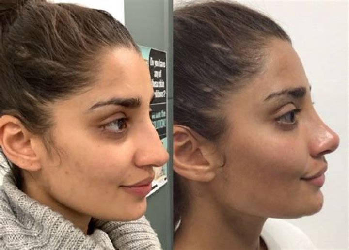 Riz Ahmed Nose Job: Before And After Photos